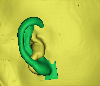 小耳畸形怎么辦?這有一份三維數(shù)字化治療方案請(qǐng)簽收!